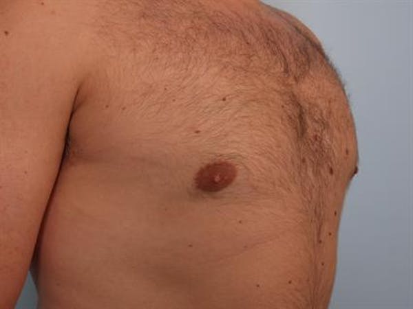 Male Breast/Areola Reduction Before & After Gallery - Patient 1311029 - Image 4