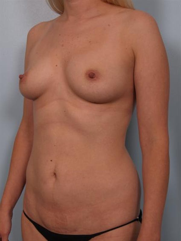 Tummy Tuck Before & After Gallery - Patient 1311028 - Image 5