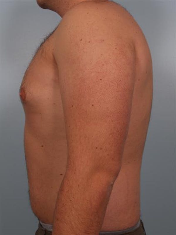 Male Breast/Areola Reduction Before & After Gallery - Patient 1311029 - Image 5