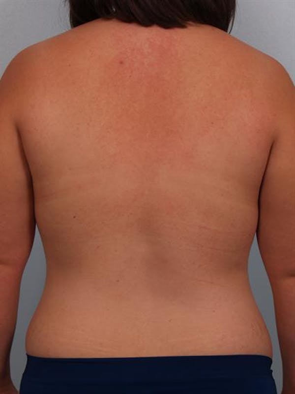 Power Assisted Liposuction Before & After Gallery - Patient 1311030 - Image 7