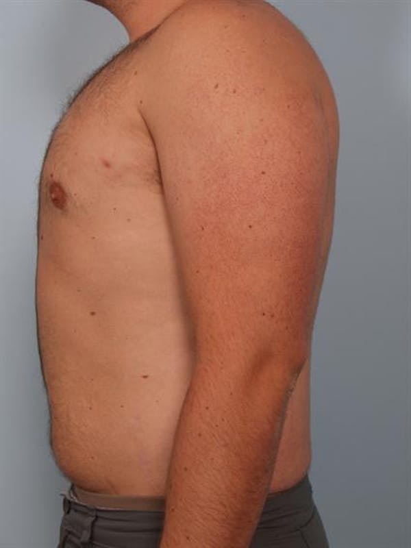 Male Breast/Areola Reduction Before & After Gallery - Patient 1311029 - Image 6