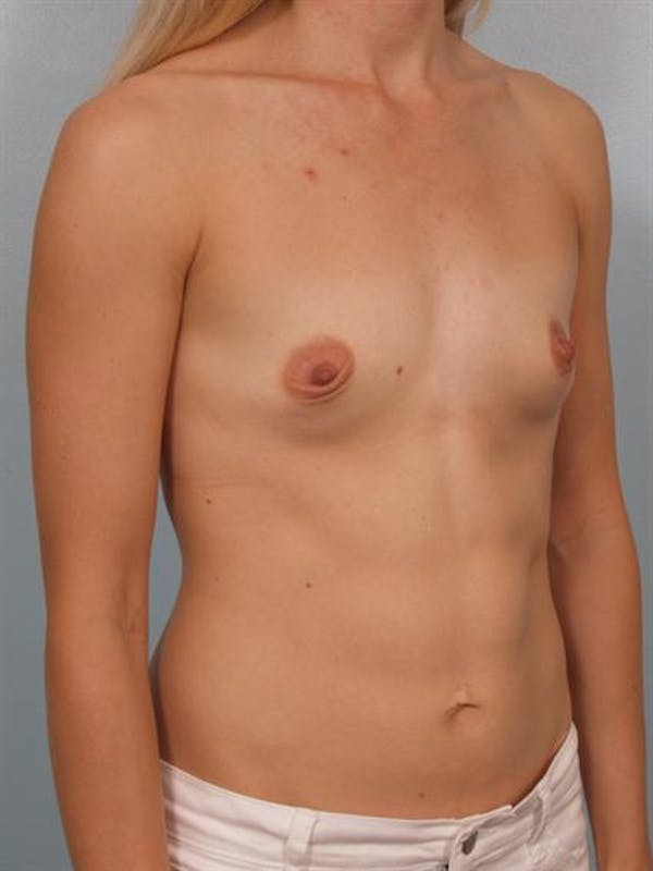 Breast Augmentation Gallery - Patient 1311031 - Image 5