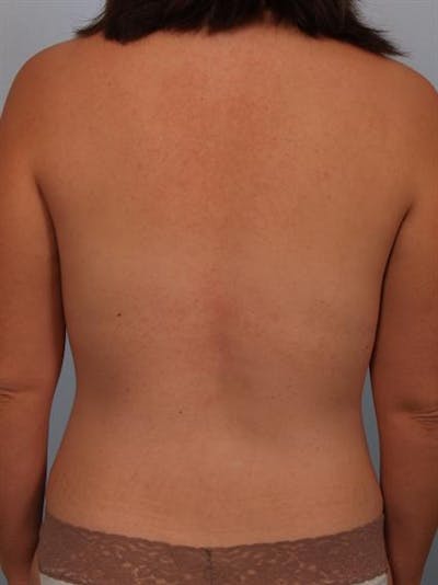 Power Assisted Liposuction Before & After Gallery - Patient 1311030 - Image 8