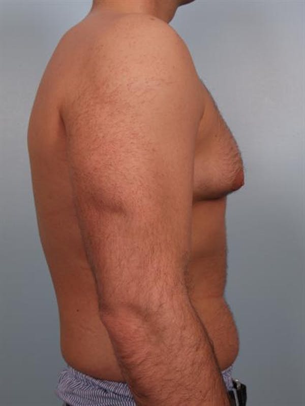Male Breast/Areola Reduction Gallery - Patient 1311034 - Image 1