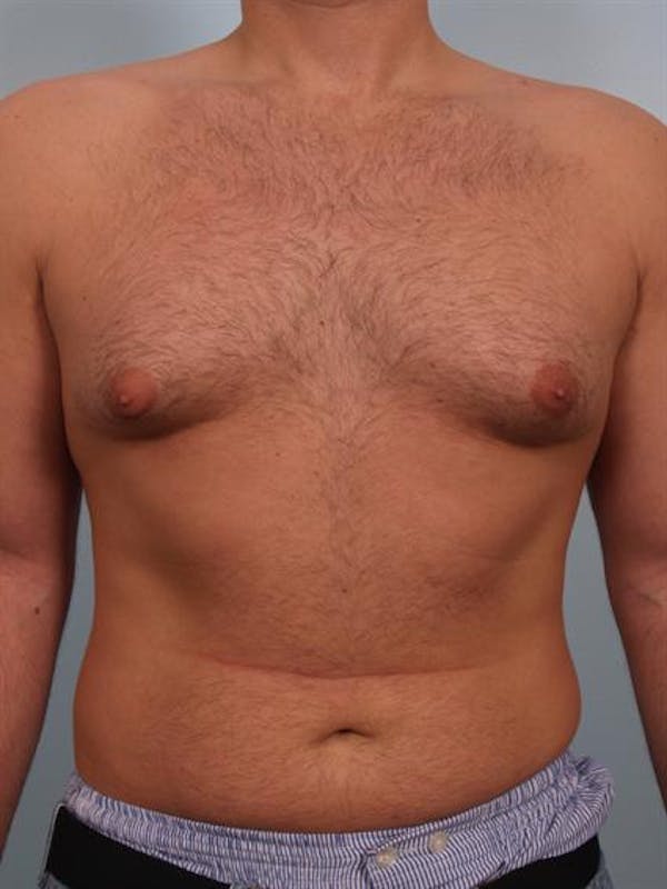 Male Breast/Areola Reduction Before & After Gallery - Patient 1311034 - Image 3