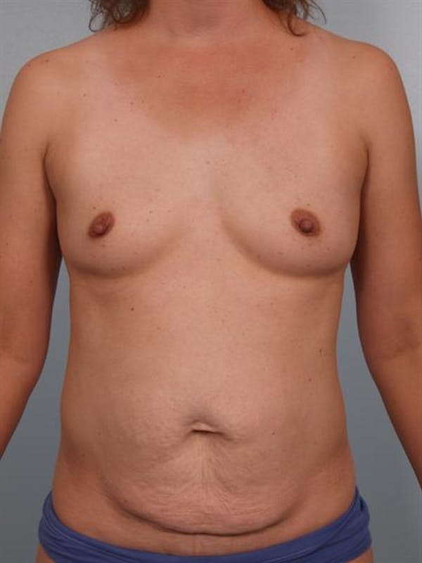 Breast Augmentation Before & After Gallery - Patient 1311037 - Image 1