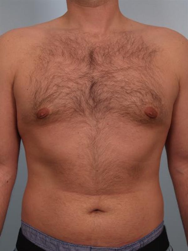 Male Breast/Areola Reduction Before & After Gallery - Patient 1311034 - Image 4