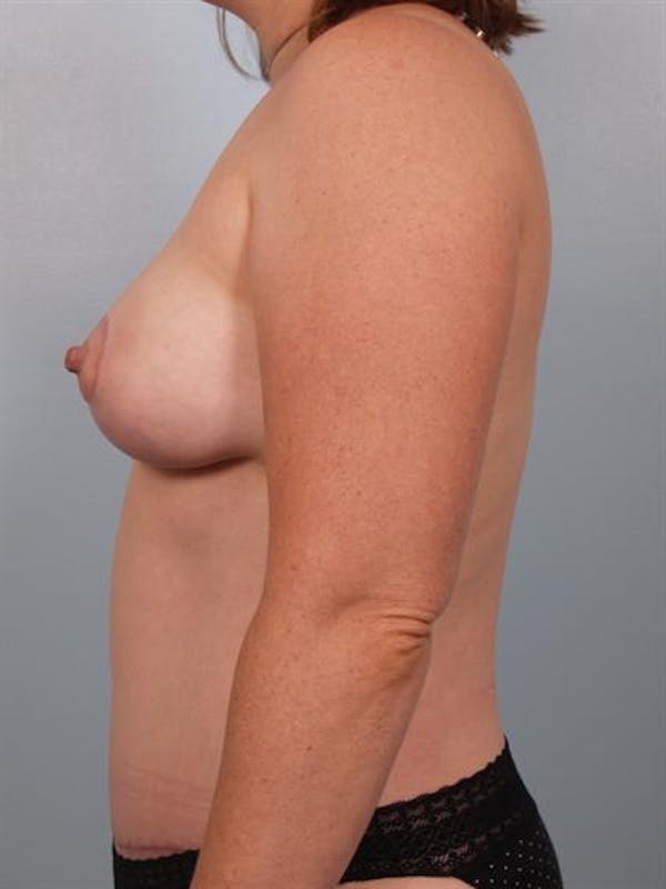 Breast Lift Before & After Gallery - Patient 1311036 - Image 4