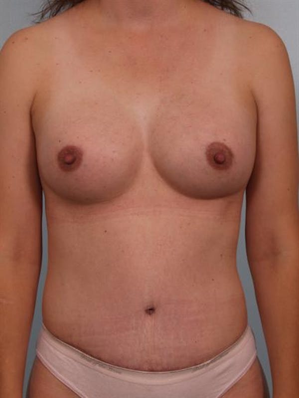 Breast Augmentation Gallery - Patient 1311037 - Image 2