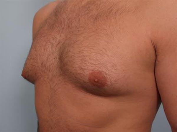 Male Breast/Areola Reduction Before & After Gallery - Patient 1311034 - Image 5