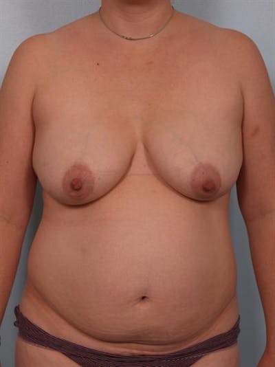 Breast Lift Before & After Gallery - Patient 1311036 - Image 1