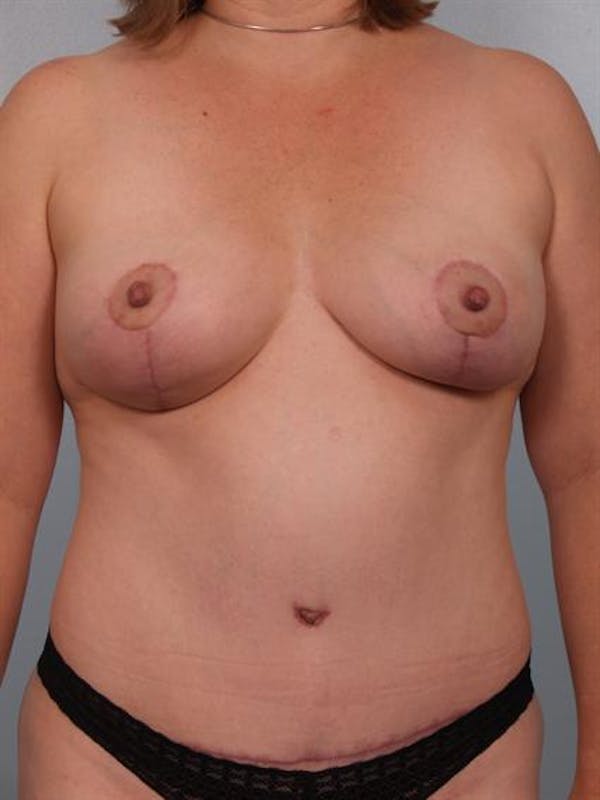 Breast Lift Before & After Gallery - Patient 1311036 - Image 2