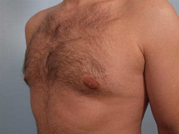 Male Breast/Areola Reduction Before & After Gallery - Patient 1311034 - Image 6