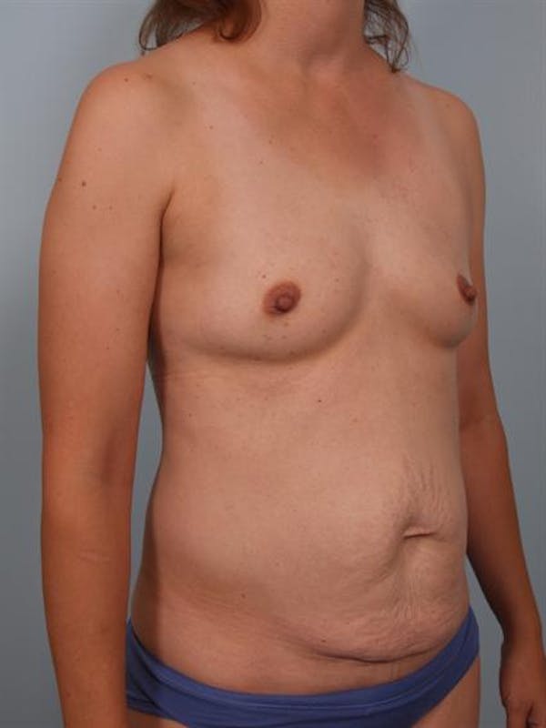 Breast Augmentation Before & After Gallery - Patient 1311037 - Image 5