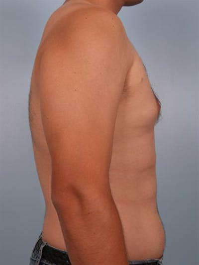 Male Breast/Areola Reduction Before & After Gallery - Patient 1311039 - Image 1