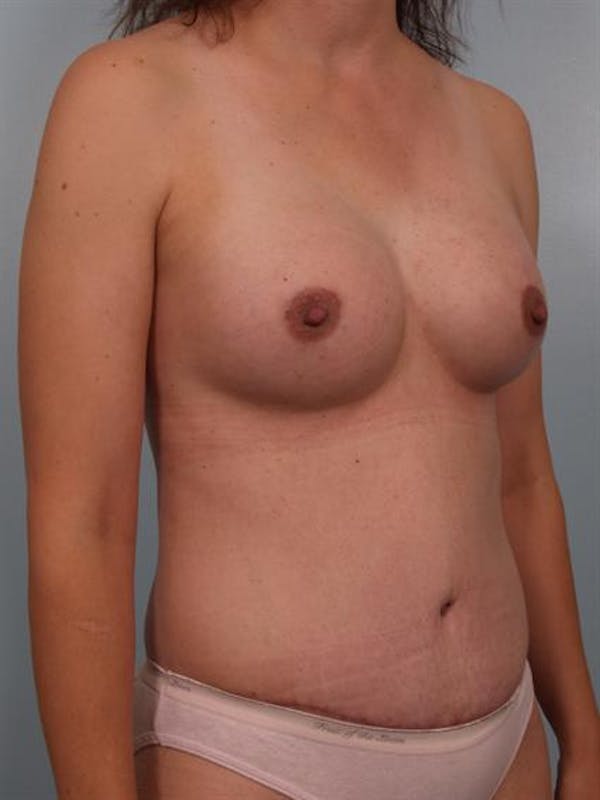 Breast Augmentation Before & After Gallery - Patient 1311037 - Image 6