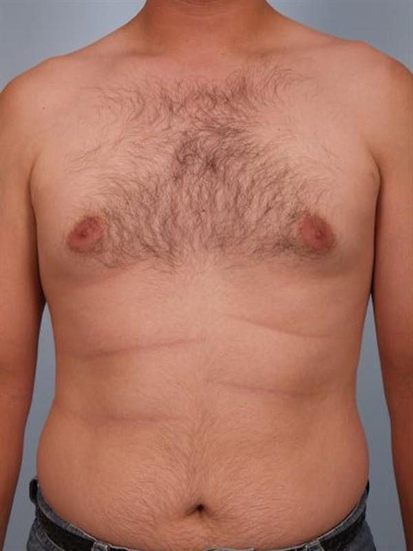 Male Breast/Areola Reduction Before & After Gallery - Patient 1311039 - Image 3