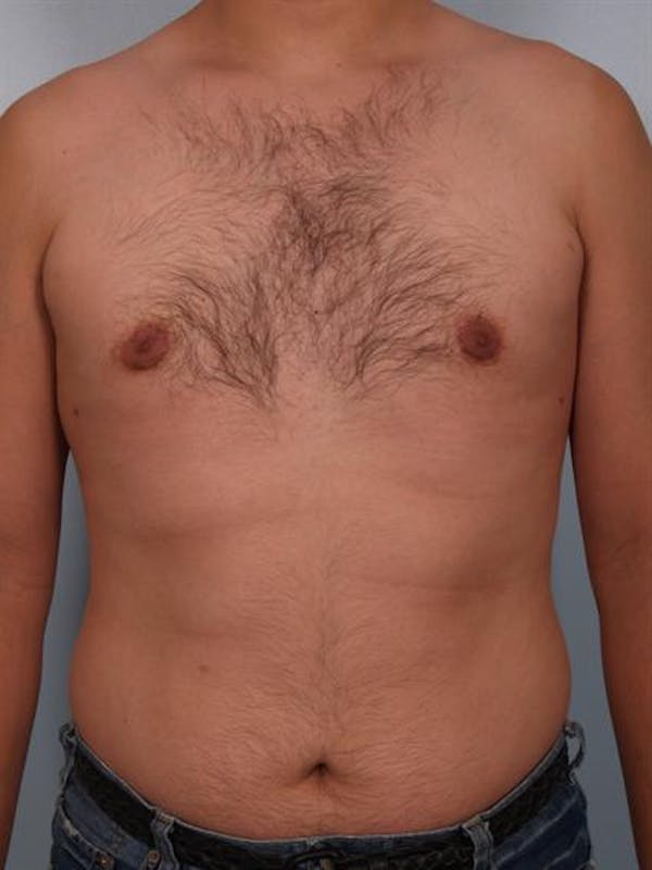 Male Breast/Areola Reduction Before & After Gallery - Patient 1311039 - Image 4