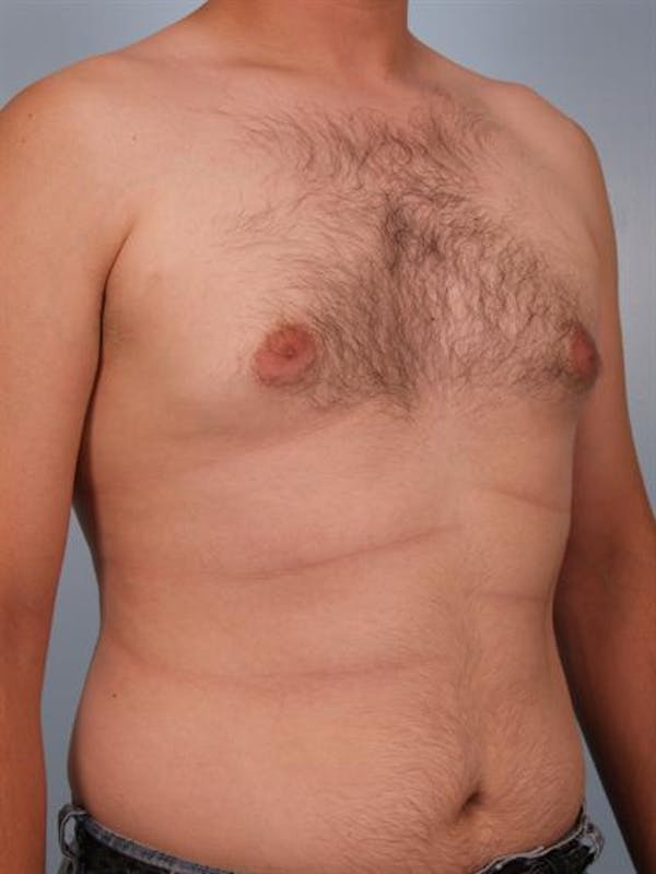 Male Breast/Areola Reduction Before & After Gallery - Patient 1311039 - Image 5