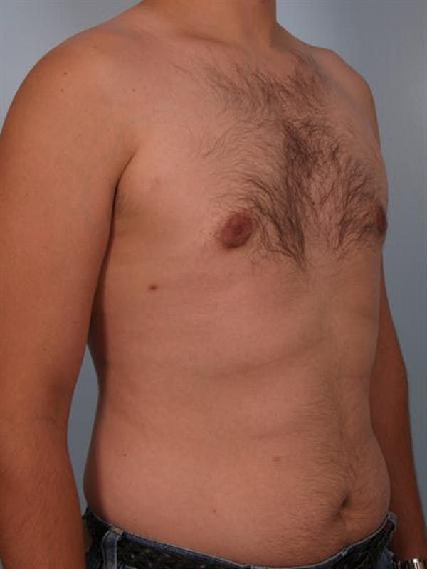 Male Breast/Areola Reduction Before & After Gallery - Patient 1311039 - Image 6