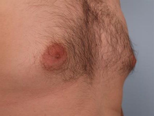 Male Breast/Areola Reduction Before & After Gallery - Patient 1311039 - Image 7