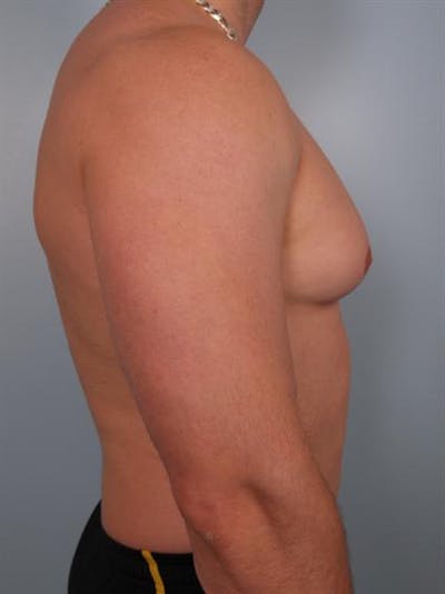 Male Breast/Areola Reduction Before & After Gallery - Patient 1311042 - Image 1
