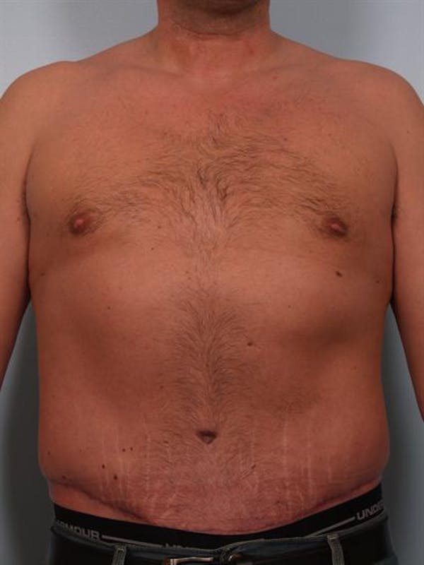 Power Assisted Liposuction Before & After Gallery - Patient 1311044 - Image 2