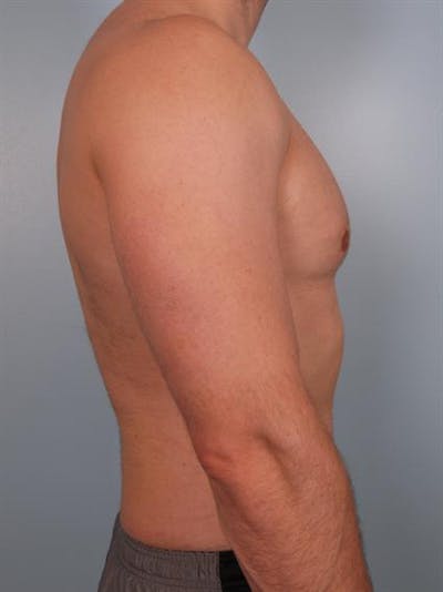 Male Breast/Areola Reduction Before & After Gallery - Patient 1311042 - Image 2