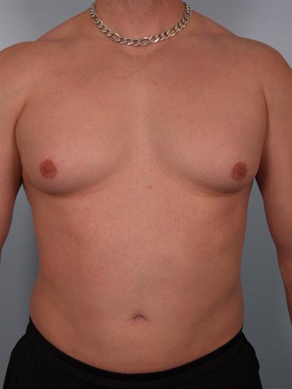 Male Breast/Areola Reduction Before & After Gallery - Patient 1311042 - Image 3