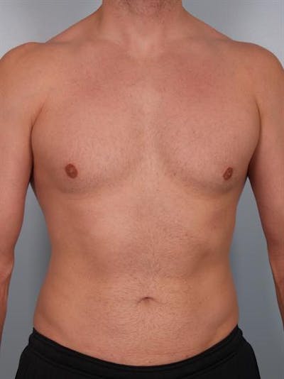 Male Breast/Areola Reduction Gallery - Patient 1311042 - Image 4