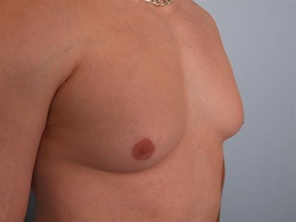 Male Breast/Areola Reduction Before & After Gallery - Patient 1311042 - Image 5