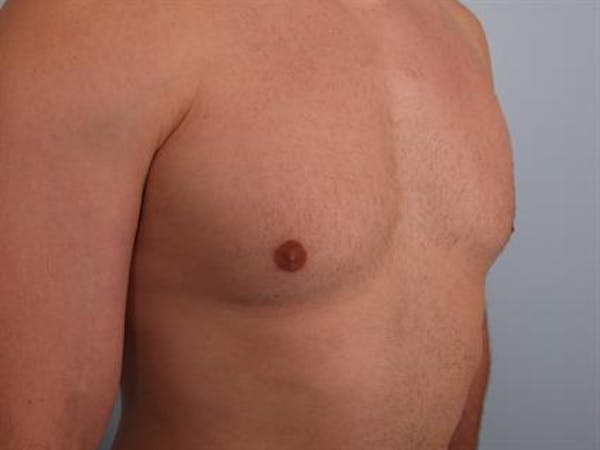 Male Breast/Areola Reduction Before & After Gallery - Patient 1311042 - Image 6