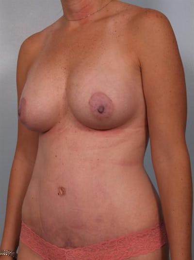 Tummy Tuck Before & After Gallery - Patient 1311043 - Image 6