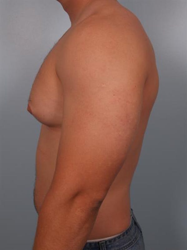 Male Breast/Areola Reduction Gallery - Patient 1311046 - Image 1