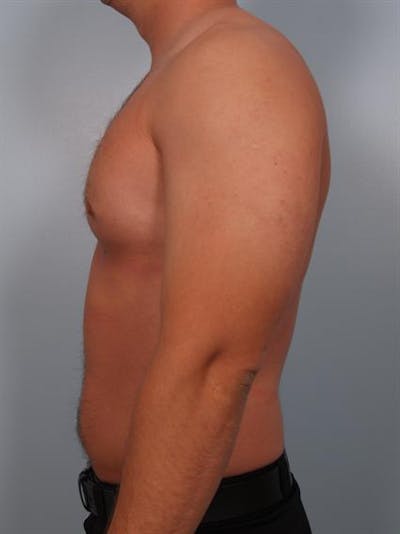 Male Breast/Areola Reduction Before & After Gallery - Patient 1311046 - Image 2
