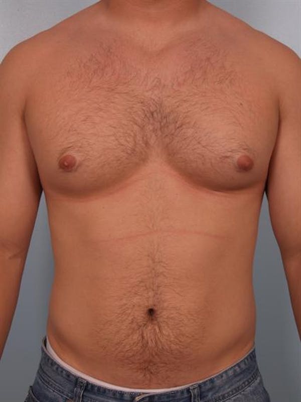 Male Breast/Areola Reduction Before & After Gallery - Patient 1311046 - Image 3