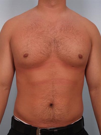 Male Breast/Areola Reduction Before & After Gallery - Patient 1311046 - Image 4