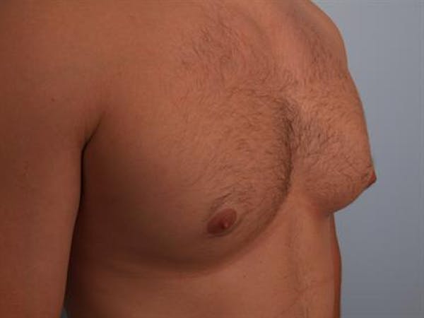 Male Breast/Areola Reduction Before & After Gallery - Patient 1311046 - Image 5