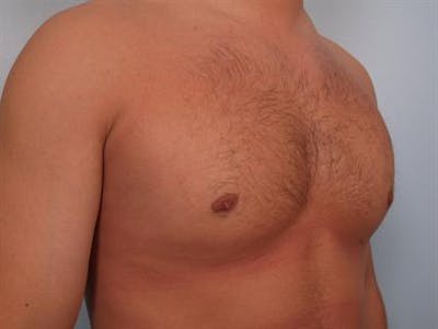 Male Breast/Areola Reduction Before & After Gallery - Patient 1311046 - Image 6