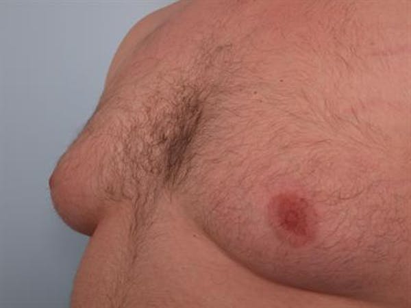 Male Breast/Areola Reduction Gallery - Patient 1311049 - Image 1