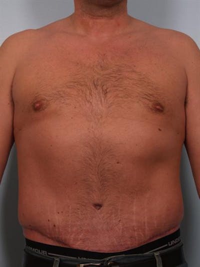 Male Breast/Areola Reduction Gallery - Patient 1311054 - Image 2