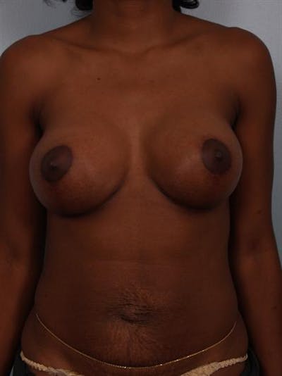 Breast Lift Before & After Gallery - Patient 1311053 - Image 2