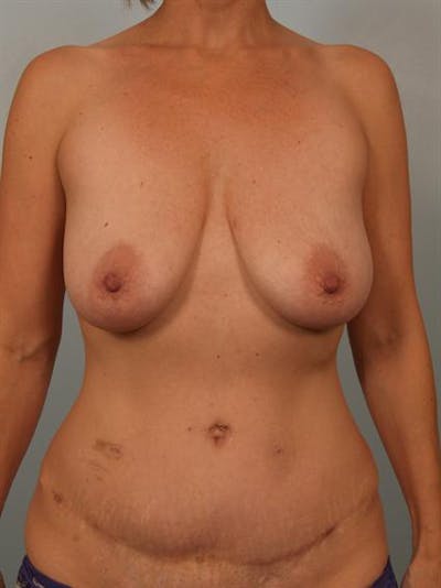 Power Assisted Liposuction Gallery - Patient 1311056 - Image 1