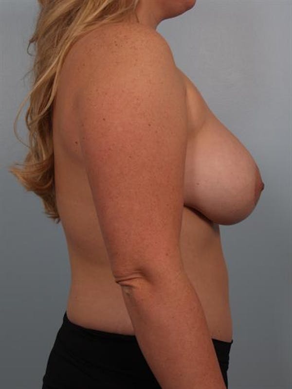 Tummy Tuck Gallery - Patient 1311055 - Image 4