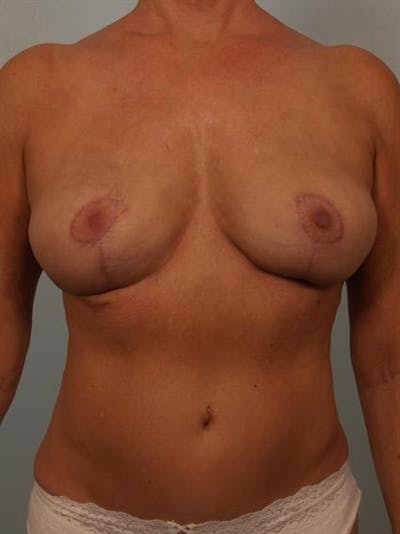 Breast Lift Before & After Gallery - Patient 1311057 - Image 2