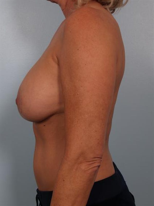 Breast Lift Gallery - Patient 1311057 - Image 5
