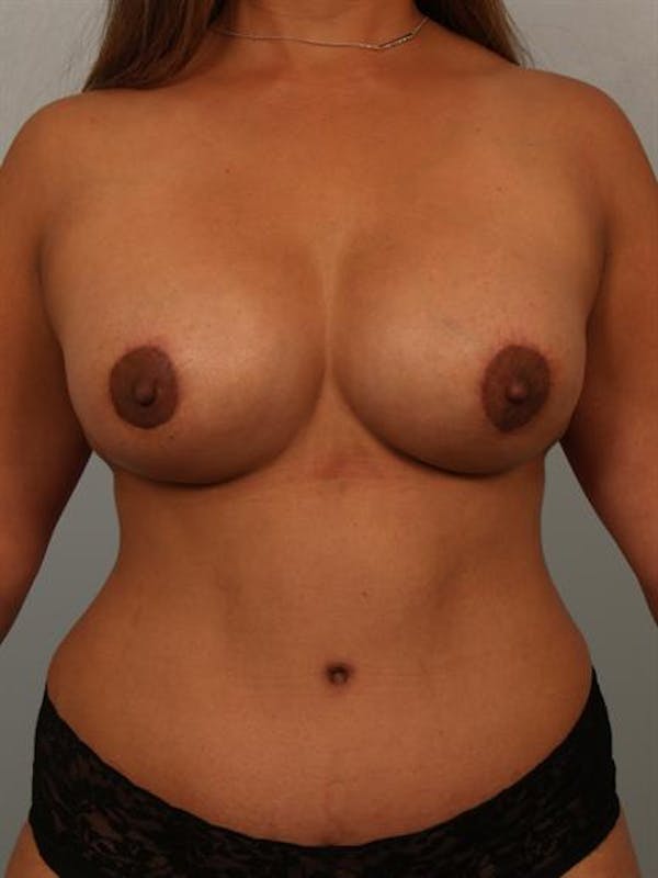 Tummy Tuck Before & After Gallery - Patient 1311061 - Image 2