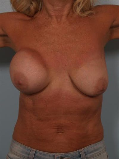 Breast Lift Before & After Gallery - Patient 1311063 - Image 1