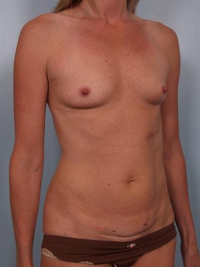 Tummy Tuck Before & After Gallery - Patient 1311065 - Image 1
