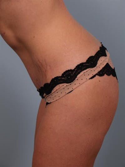Tummy Tuck Before & After Gallery - Patient 1311065 - Image 8